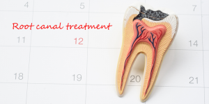 root canal appointment in calendar